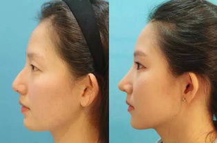 中国十大隆鼻专家，中国最漂亮的隆鼻