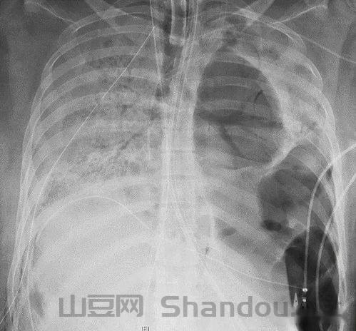 换肺是什么病,换肺疫情
